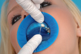 OptraDam Plus. ���������� ��������� 50 ��